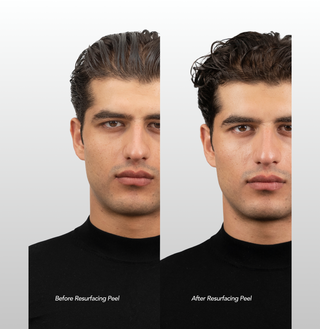 Resurfacing Peel